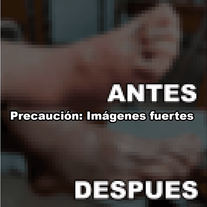Curación de pie diabético